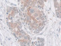 DAB staining on IHC-P; Samples: Human Prostate cancer Tissue; Primary Ab: 10µg/ml Rabbit Anti-Human Maspin Antibody Second Ab: 2µg/mL HRP-Linked Caprine Anti-Rabbit IgG Polyclonal Antibody DAB staining on IHC-P; Samples: Human Prostate cancer Tissue; Primary Ab: 10µg/ml Rabbit Anti-Human Maspin Antibody Second Ab: 2µg/mL HRP-Linked Caprine Anti-Rabbit IgG Polyclonal Antibody