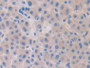DAB staining on IHC-P; Samples: Human Liver cancer Tissue; Primary Ab: 30µg/ml Rabbit Anti-Human Slit1 Antibody Second Ab: 2µg/mL HRP-Linked Caprine Anti-Rabbit IgG Polyclonal Antibody DAB staining on IHC-P; Samples: Human Liver cancer Tissue; Primary Ab: 30µg/ml Rabbit Anti-Human Slit1 Antibody Second Ab: 2µg/mL HRP-Linked Caprine Anti-Rabbit IgG Polyclonal Antibody