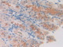 DAB staining on IHC-P; Samples: Human Stomach Cancer Tissue DAB staining on IHC-P; Samples: Human Stomach Cancer Tissue