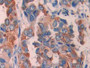 DAB staining on IHC-P; Samples: Human Breast cancer Tissue; Primary Ab: 30µg/ml Rabbit Anti-Human ECT2 Antibody Second Ab: 2µg/mL HRP-Linked Caprine Anti-Rabbit IgG Polyclonal Antibody