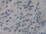 DAB staining on IHC-P; Samples: Human Breast Cancer Tissue. DAB staining on IHC-P; Samples: Human Breast Cancer Tissue.