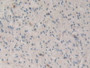 DAB staining on IHC-P; Samples: Human Glioma Tissue.