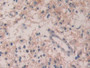 DAB staining on IHC-P; Samples: Human Glioma Tissue; Primary Ab: 30µg/ml Rabbit Anti-Human IL35 Antibody Second Ab: 2µg/mL HRP-Linked Caprine Anti-Rabbit IgG Polyclonal Antibody DAB staining on IHC-P; Samples: Human Glioma Tissue; Primary Ab: 30µg/ml Rabbit Anti-Human IL35 Antibody Second Ab: 2µg/mL HRP-Linked Caprine Anti-Rabbit IgG Polyclonal Antibody