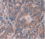 DAB staining on IHC-P; Samples: Human Rectum Cancer Tissue DAB staining on IHC-P; Samples: Human Rectum Cancer Tissue