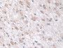 DAB staining on IHC-P; Samples: Human Glioma Tissue; Primary Ab: 10µg/ml Rabbit Anti-Human tPK1 Antibody Second Ab: 2µg/mL HRP-Linked Caprine Anti-Rabbit IgG Polyclonal Antibody DAB staining on IHC-P; Samples: Human Glioma Tissue; Primary Ab: 10µg/ml Rabbit Anti-Human tPK1 Antibody Second Ab: 2µg/mL HRP-Linked Caprine Anti-Rabbit IgG Polyclonal Antibody