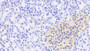 DAB staining on IHC-P; Samples: Human Pancreas Tissue;  Primary Ab: 20μg/ml Rabbit Anti-Human ADAMTS1 Antibody Second Ab: 2µg/mL HRP-Linked Caprine Anti-Rabbit IgG Polyclonal Antibody  DAB staining on IHC-P; Samples: Human Pancreas Tissue;  Primary Ab: 20μg/ml Rabbit Anti-Human ADAMTS1 Antibody Second Ab: 2µg/mL HRP-Linked Caprine Anti-Rabbit IgG Polyclonal Antibody