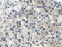 DAB staining on IHC-P; Samples: Human Prostate cancer Tissue; Primary Ab: 20µg/ml Rabbit Anti-Human SCCA1/SCCA2 Antibody Second Ab: 2µg/mL HRP-Linked Caprine Anti-Rabbit IgG Polyclonal Antibody