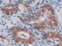 DAB staining on IHC-P; Samples: Human Lung Cancer Tissue