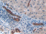 DAB staining on IHC-P; Samples: Human Liver cancer Tissue; Primary Ab: 20µg/ml Rabbit Anti-Human GROb Antibody Second Ab: 2µg/mL HRP-Linked Caprine Anti-Rabbit IgG Polyclonal Antibody