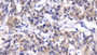 DAB staining on IHC-P; Samples: Human Lymphoma Tissue;  Primary Ab: 20μg/ml Rabbit Anti-Human BLC1 Antibody Second Ab: 2µg/mL HRP-Linked Caprine Anti-Rabbit IgG Polyclonal Antibody 