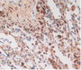 DAB staining on IHC-P; Samples: Human Lung Cancer Tissue.