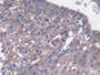 DAB staining on IHC-P; Samples: Human Lung cancer Tissue;  Primary Ab: 20µg/ml Rabbit Anti-Human MAP