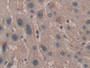 DAB staining on IHC-P; Samples: Human Liver cancer Tissue; Primary Ab: 20µg/ml Rabbit Anti-Human MYL2 Antibody Second Ab: 2µg/mL HRP-Linked Caprine Anti-Rabbit IgG Polyclonal Antibody