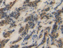 DAB staining on IHC-P; Samples: Human Breast cancer Tissue; Primary Ab: 20µg/ml Rabbit Anti-Human HSPA1A Antibody Second Ab: 2µg/mL HRP-Linked Caprine Anti-Rabbit IgG Polyclonal Antibody