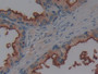 DAB staining on IHC-P; Samples: Human Prostate Tissue; Primary Ab: 10µg/ml Rabbit Anti-Human AAP Antibody Second Ab: 2µg/mL HRP-Linked Caprine Anti-Rabbit IgG Polyclonal Antibody