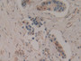 DAB staining on IHC-P; Samples: Human Breast cancer Tissue; Primary Ab: 10µg/ml Rabbit Anti-Human SOD4 Antibody Second Ab: 2µg/mL HRP-Linked Caprine Anti-Rabbit IgG Polyclonal Antibody