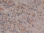 DAB staining on IHC-P; Samples: Human Prostate cancer Tissue; Primary Ab: 10µg/ml Rabbit Anti-Human CYCS Antibody Second Ab: 2µg/mL HRP-Linked Caprine Anti-Rabbit IgG Polyclonal Antibody