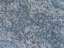 DAB staining on IHC-P; Samples: Human Skin cancer Tissue