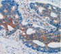 DAB staining on IHC-P; Samples: Human Rectum Cancer Tissue.