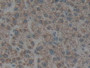 DAB staining on IHC-P; Samples: Human Liver Cancer Tissue.
