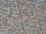 DAB staining on IHC-P; Samples: Human Liver cancer Tissue; Primary Ab: 10µg/ml Rabbit Anti-Human EDN1 Antibody Second Ab: 2µg/mL HRP-Linked Caprine Anti-Rabbit IgG Polyclonal Antibody