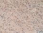 DAB staining on IHC-P; Samples: Human Glioma Tissue.