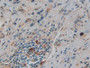 DAB staining on IHC-P; Samples: Human Prostate cancer Tissue; Primary Ab: 10µg/ml Rabbit Anti-Human GS Antibody Second Ab: 2µg/mL HRP-Linked Caprine Anti-Rabbit IgG Polyclonal Antibody