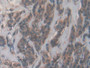 DAB staining on IHC-P; Samples: Human Breast cancer Tissue; Primary Ab: 20µg/ml Rabbit Anti-Human ACP Antibody Second Ab: 2µg/mL HRP-Linked Caprine Anti-Rabbit IgG Polyclonal Antibody DAB staining on IHC-P; Samples: Human Breast cancer Tissue; Primary Ab: 20µg/ml Rabbit Anti-Human ACP Antibody Second Ab: 2µg/mL HRP-Linked Caprine Anti-Rabbit IgG Polyclonal Antibody