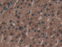 DAB staining on IHC-P; Samples: Human Liver Cancer Tissue. DAB staining on IHC-P; Samples: Human Liver Cancer Tissue.