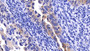 DAB staining on IHC-P; Samples: Human Endometrial cancer Tissue; Primary Ab: 20μg/ml Rabbit Anti-Human MMP7 Antibody Second Ab: 2µg/mL HRP-Linked Caprine Anti-Rabbit IgG Polyclonal Antibody