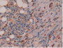 DAB staining on IHC-P; Samples: Human Skin Cancer Tissue