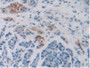 DAB staining on IHC-P; Samples: Human Pancreas Cancer Tissue