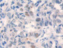 DAB staining on IHC-P; Samples: Human Breast cancer Tissue)