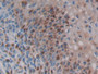 DAB staining on IHC-P; Samples: Human Skin cancer Tissue; Primary Ab: 20µg/ml Rabbit Anti-Human CCL3L1 Antibody Second Ab: 2µg/mL HRP-Linked Caprine Anti-Rabbit IgG Polyclonal Antibody