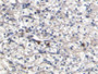 DAB staining on IHC-P; Samples: Human Renal cancer Tissue;  Primary Ab: 20µg/ml Mouse Anti-Human S10