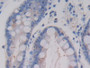 DAB staining on IHC-P; Samples: Human Stomach cancer Tissue; Primary Ab: 20µg/ml Mouse Anti-Fish AMH Antibody Second Ab: 2µg/mL HRP-Linked Caprine Anti-Mouse IgG Polyclonal Antibody