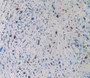 Figure. DAB staining on IHC-P; Samples: Human Stomach Cancer Tissue.