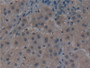 DAB staining on IHC-P; Samples: Human Liver cancer Tissue; Primary Ab: 30µg/ml Mouse Anti-Human NOG Antibody Second Ab: 2µg/mL HRP-Linked Caprine Anti-Mouse IgG Polyclonal Antibody