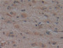 DAB staining on IHC-P; Samples: Human Liver cancer Tissue)