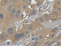 DAB staining on IHC-P; Samples: Human Esophagus Tissue; Primary Ab: 30µg/ml Mouse Anti-Human GAL7 Antibody Second Ab: 2µg/mL HRP-Linked Caprine Anti-Mouse IgG Polyclonal Antibody