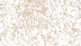 DAB staining on IHC-P; Samples: Human Ovarian cancer Tissue; Primary Ab: 10µg/ml Mouse Anti-Human GAL3 Antibody Second Ab: 2µg/mL HRP-Linked Caprine Anti-Mouse IgG Polyclonal Antibody