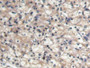 DAB staining on IHC-P; Samples: Human Renal cancer Tissue;  Primary Ab: 20µg/ml Mouse Anti-Human BMP