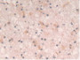 DAB staining on IHC-P; Samples: Human Glioma Tissue