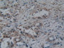 DAB staining on IHC-P; Samples: Human Breast Cancer Tissue