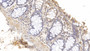 DAB staining on IHC-P; Samples: Human Colon Tissue; Primary Ab: 10µg/ml Mouse Anti-Human GS Antibody Second Ab: 2µg/mL HRP-Linked Caprine Anti-Mouse IgG Polyclonal Antibody