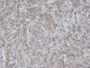 DAB staining on IHC-P; Samples: Porcine Breast cancer Tissue; Primary Ab: 20µg/ml Rabbit Anti-Porcine CLPS Antibody Second Ab: 2µg/mL HRP-Linked Caprine Anti-Rabbit IgG Polyclonal Antibody