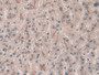 DAB staining on IHC-P; Samples: Human Liver cancer Tissue;  Primary Ab: 20µg/ml Rabbit Anti-Human CT