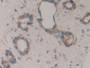 DAB staining on IHC-P; Samples: Human Bile duct cancer Tissue;  Primary Ab: 10µg/ml Rabbit Anti-Huma