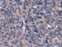 DAB staining on IHC-P; Samples: Human Ovarian cancer Tissue; Primary Ab: 20µg/ml Mouse Anti-Human aFP Antibody Second Ab: 2µg/mL HRP-Linked Caprine Anti-Mouse IgG Polyclonal Antibody