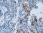 DAB staining on IHC-P; Samples: Human Liver cancer Tissue; Primary Ab: 30µg/ml Mouse Anti-Human IL19 Antibody Second Ab: 2µg/mL HRP-Linked Caprine Anti-Mouse IgG Polyclonal Antibody